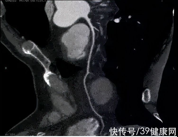 心血管疾病|84岁大爷斑块消失，他把血管变“干净”的2个方法，连医生也赞叹