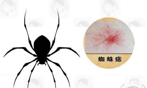 肝脏CT|以为是过敏,其实是患癌!皮肤若有3个变化,最好做个肝脏CT