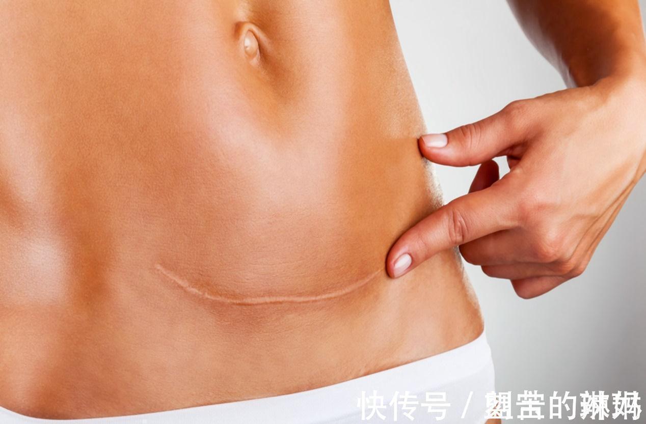 产妇|剖宫产“横竖”怎么选择?哪个更有利于产后恢复?医生教你这么选