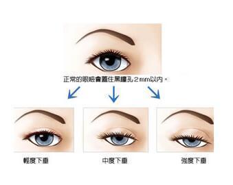 关于重症肌无力,你可能不知道的四点