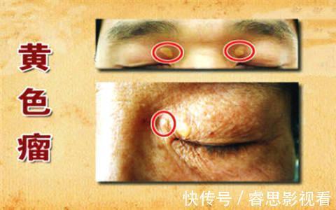 血脂升高|高血脂怎么降低？2个小方法，坚持15天，血脂降了、人更加精神了