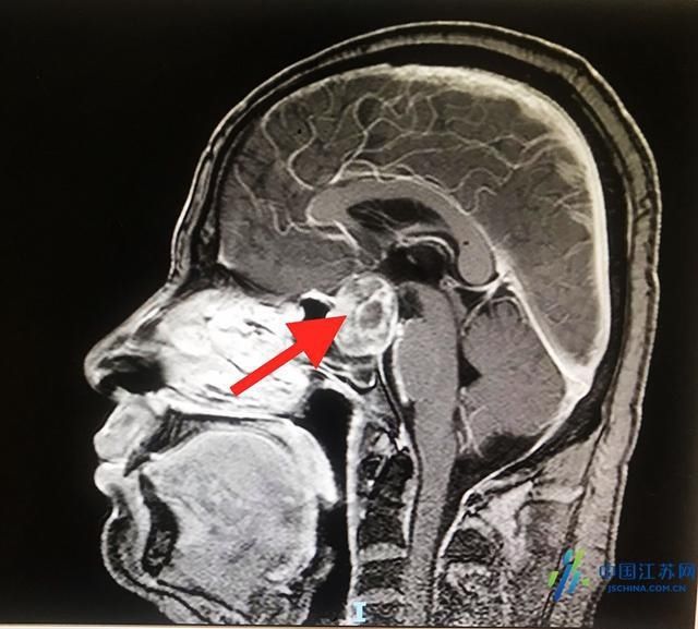  竟是|男子突发头痛失明 竟是凶险的垂体瘤卒中
