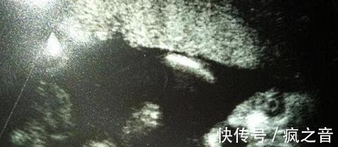 肚子|B超下!肚子里的婴儿竟朝母亲露出凶相