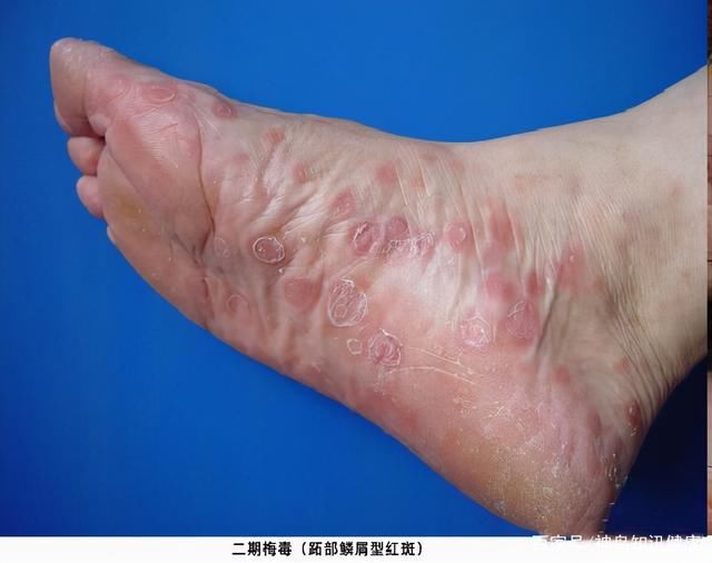 确诊|25岁男子浑身长红斑，确诊梅毒后向医生承认：一直抱有侥幸心理