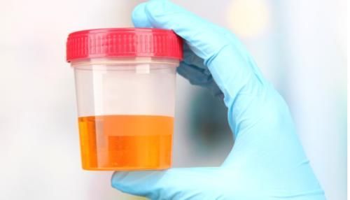 尿液|如何判断高血压伴有肾功能损害?2个检查,3项指标必须知晓