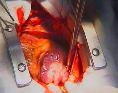 先天性心脏病|心脏彩超能检查出什么病来?心血管医生:这几种心脏病都可以