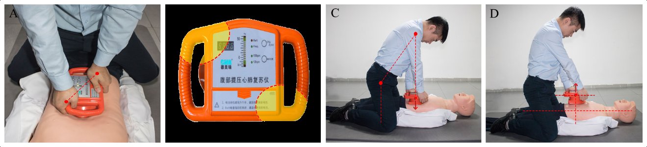 心肺复苏|腹部提压心肺复苏术，该出手时就出手