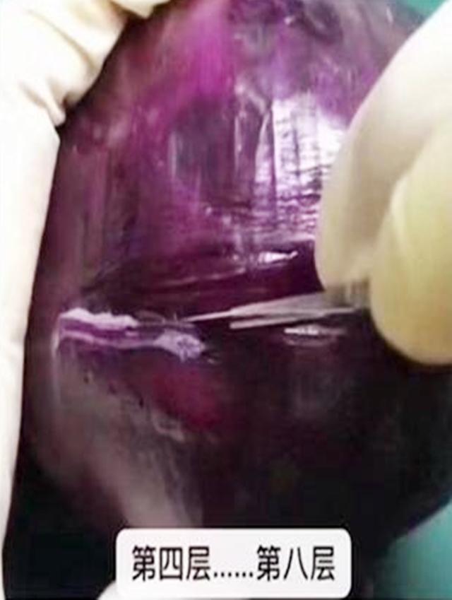 麻醉针|选剖腹产不疼这根10厘米的麻醉针仅仅是开始,疼到你怀疑人生