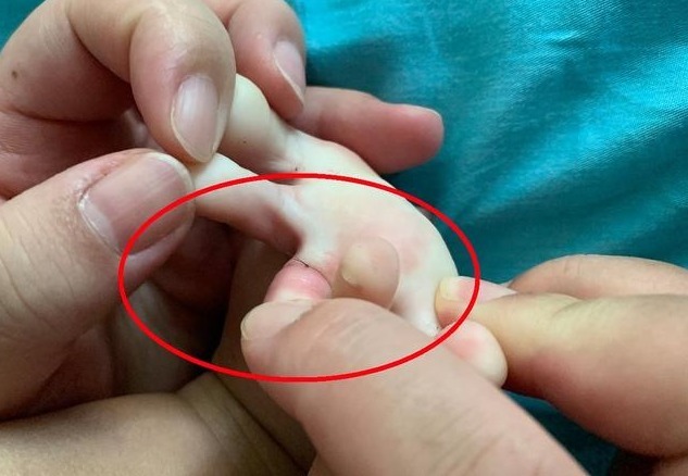 宝宝|2岁宝宝脚趾有“虫子”，妈妈连忙带去检查，医生幸好来得及时