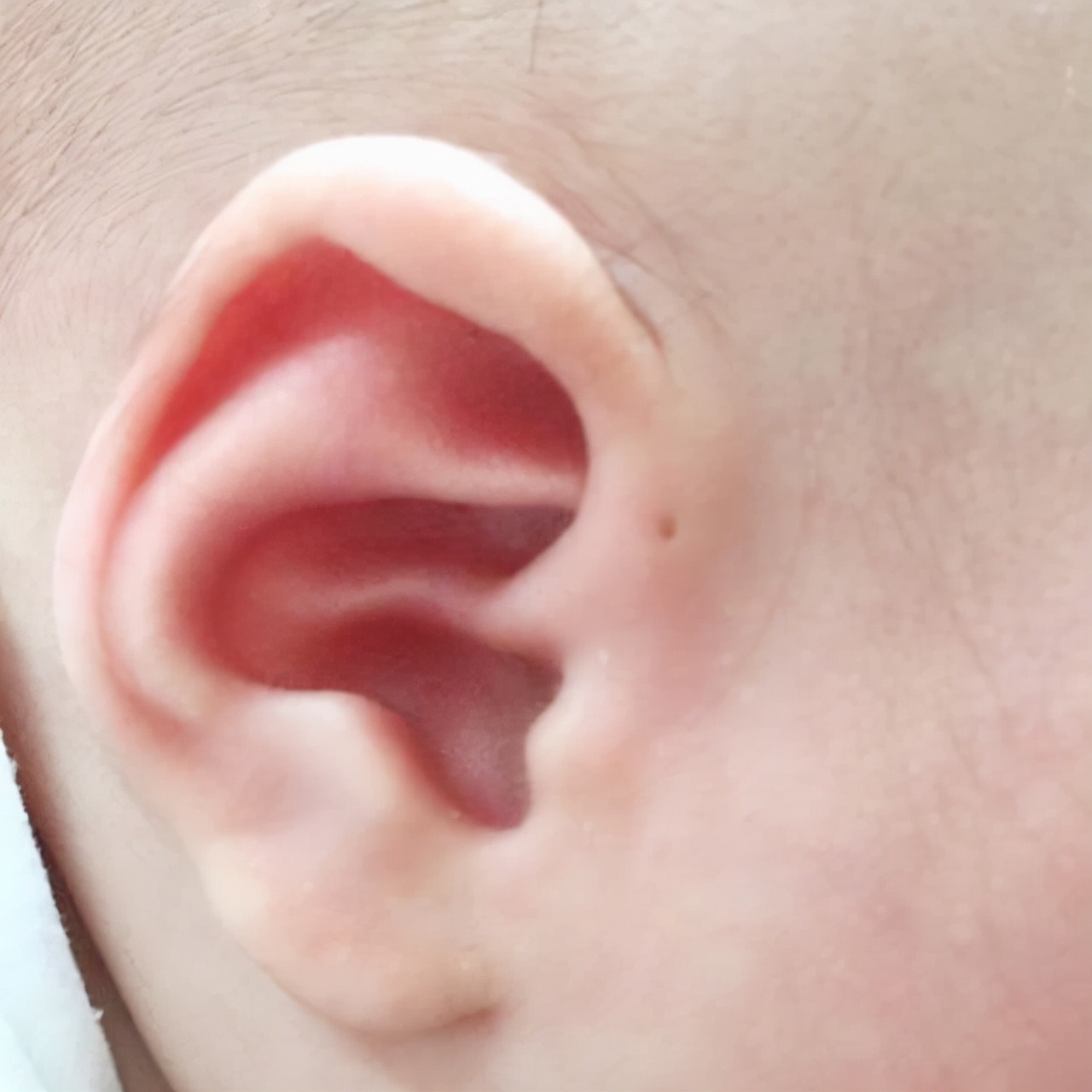 发炎|娃耳朵上的“小孔”是聪明洞医生通常不会明说，妈妈要心知肚明
