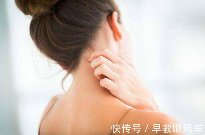 荨麻疹|夏季皮肤过敏反复发怎么办?反复发作要做的这三件事情要记住