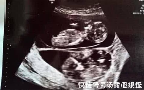 小方|孕妈喜怀“双胞胎”,产检时医生摇头两次受孕怀上的,并非好事