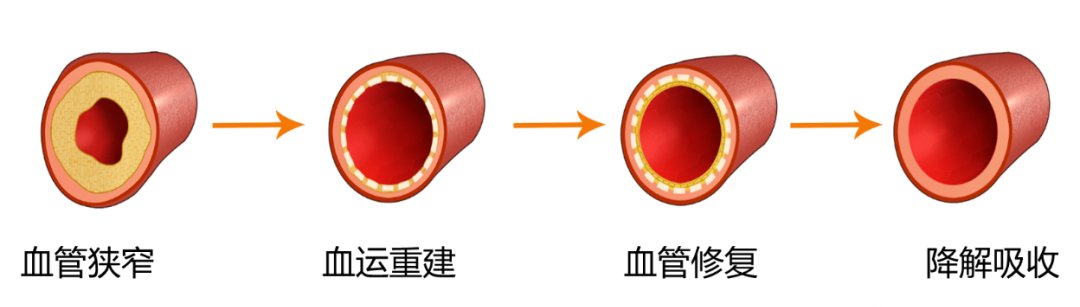 乳酸|【健哥说心脏】会消失的支架,你需要了解
