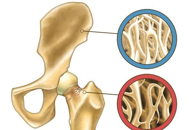 男女|骨科主任:不论男女,常吃这4物,可增加骨密度,远离骨质疏松