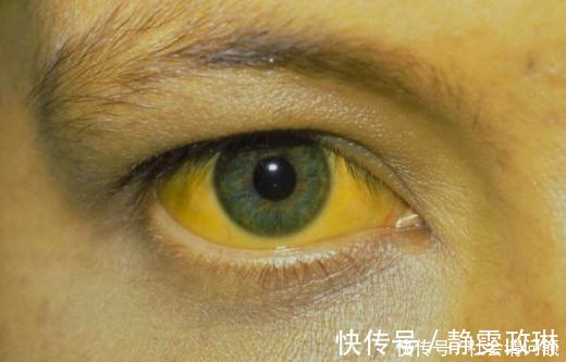 朋友|伤肝“水果”被揪出,可惜很多老年朋友当成宝,劝你早忌嘴