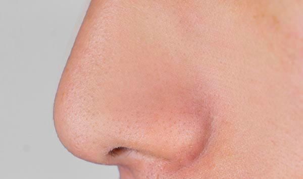 黑头|鼻子里总能挤出的“小白条”是什么？怎么能够快速去除？