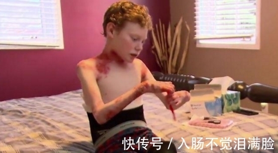 乔纳森|男孩皮肤一碰就流血,每天裹满纱布,泡在浴缸里减轻痛苦