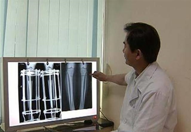 断骨|当年因矮身高自卑，花16万断骨增高7.2厘米的李亚诺，后来如何？