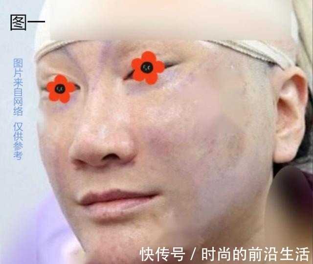 求美者 做了“假拉皮”手术,危害有多大!