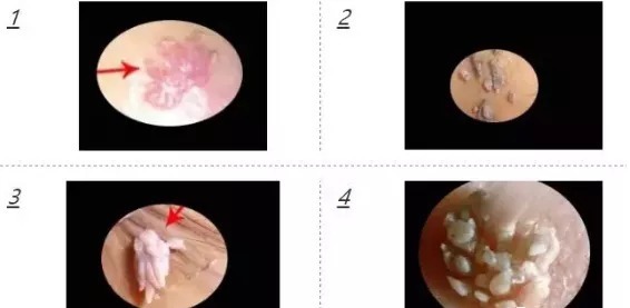 复发|尖锐湿疣复发的症状图片