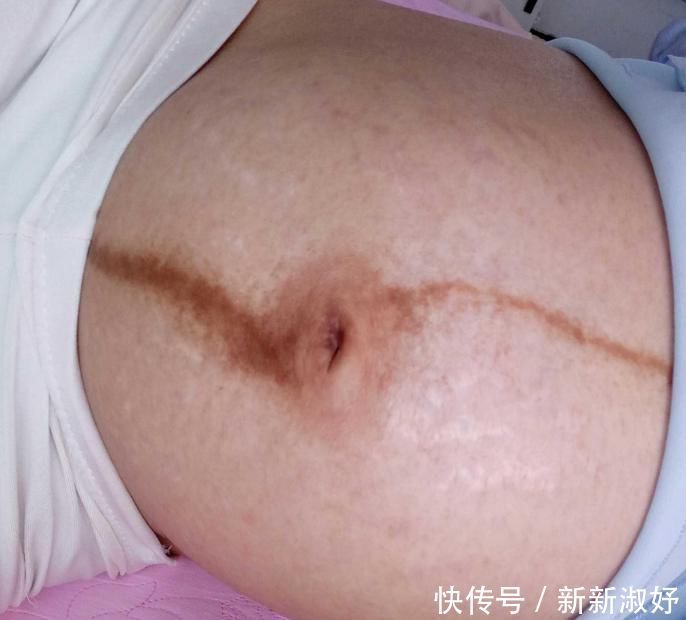 怀孕之后肚子上浮现一条“黑线”，妈妈嫌丑婆婆嫌细，别再迷信了