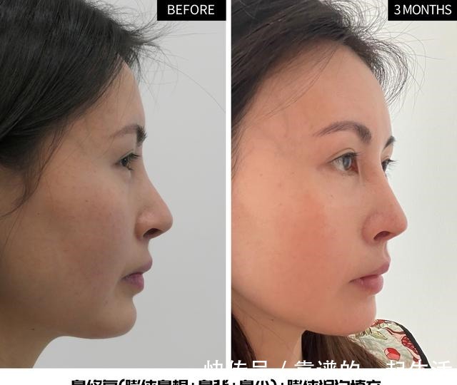 黑眼圈 求美者很想撤回的照片,真实记录泪沟、鼻修复术后3个月效果变化!