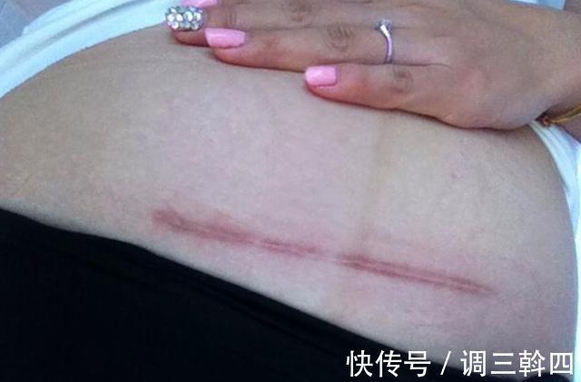 伤口|女性剖腹产后,有3件事不管多痛都要忍过去,不然容易吃亏