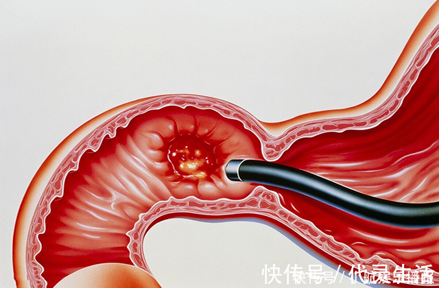 胃部|消化科大夫：水里加一物，坚持3周，冲走幽门螺杆菌，胃病自破