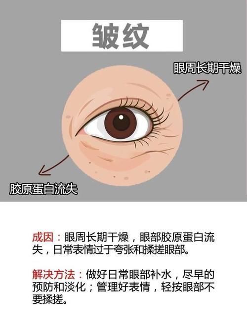 眼部|黑眼圈 、眼袋、 眼角纹、 脂肪粒，它们的形成原因你知道吗？
