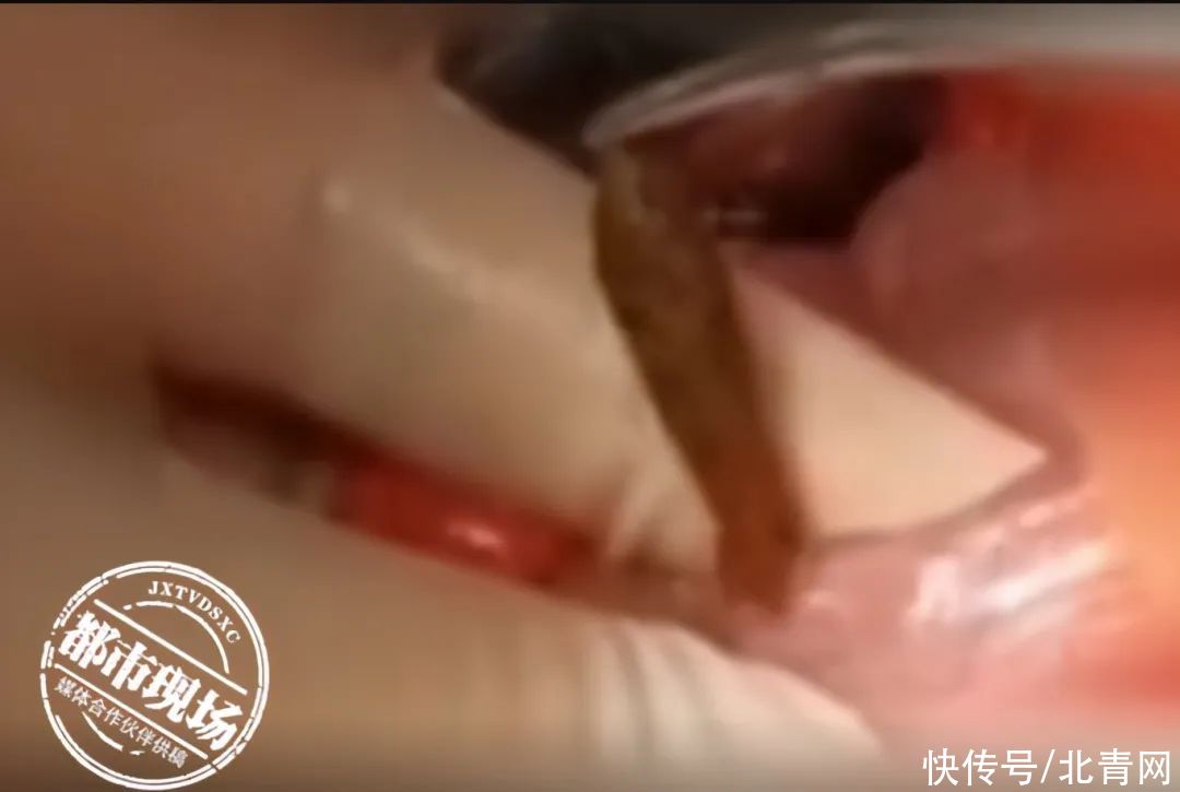 枣核|女子吃粽子后紧急送医，她说“好悬没死过去”