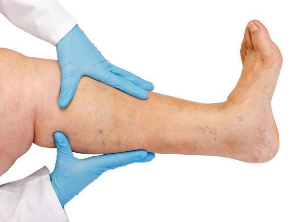 体内有血栓,身体这2处会提前告知,预防血栓要做好这些事