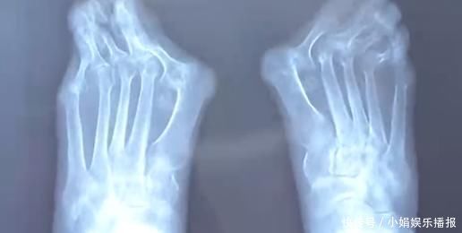 外翻|爱穿高跟鞋的女性一定要小心,拇指外翻堪比“裹脚”!不可忽视