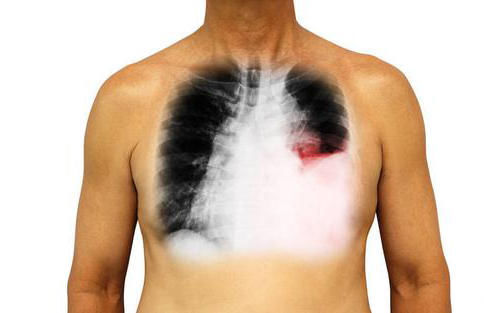 肯能性|有些症状不可忽视,可能是肺癌的肺外表现,早诊断早治疗痛苦小