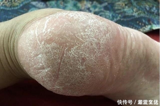 秘方|脚上老皮、老茧又干又硬!一个民间小秘方学会,双脚变的白白嫩嫩