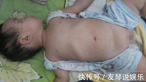 检查|6个月大的宝宝脊椎变形,医院检查后,得知原因让父母后悔不已