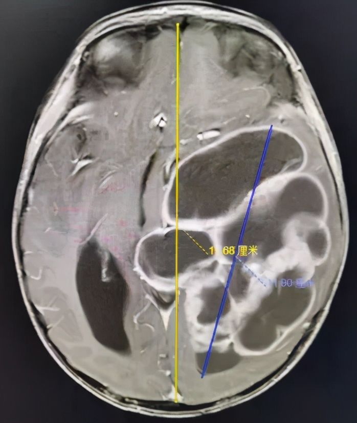 折翼天使们|2岁就查出肿瘤！这些让人心疼的折翼天使们，后来怎么样了？