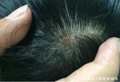 头皮上长出小疙瘩,可能是有大问题,为了