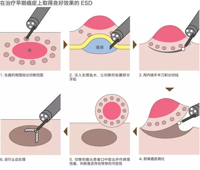 消化内科|快来看看内镜医生的杀手锏吧！