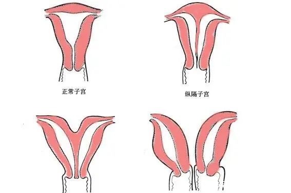 怀孕|女性｜双子宫能怀孕吗？