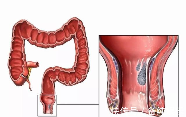 炎症|从炎症到癌症,警惕以下7种炎症成为癌症“帮凶”
