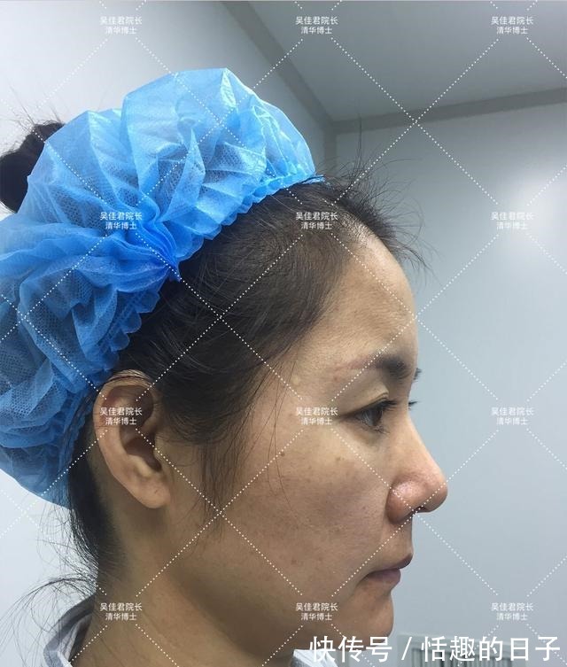 线雕 44岁小拉皮术后5个半月,用亲身经历谈一谈我的感受!