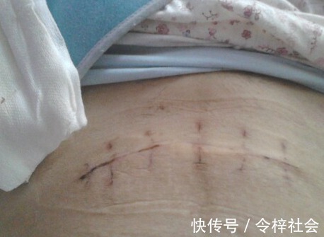 孕妈们|女性剖腹产时选“横切”还是“竖切”对身体好产科大夫说了实话