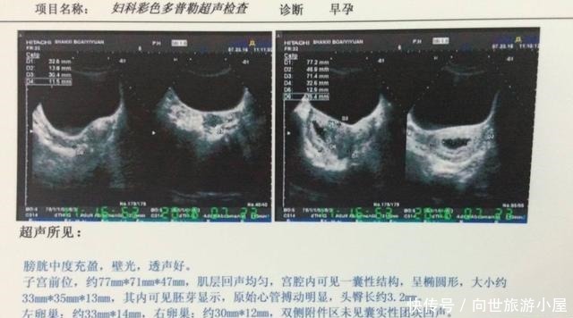 产检|产检想知道男女，这样套话能让医生“说漏嘴”，斗智斗勇满满套路