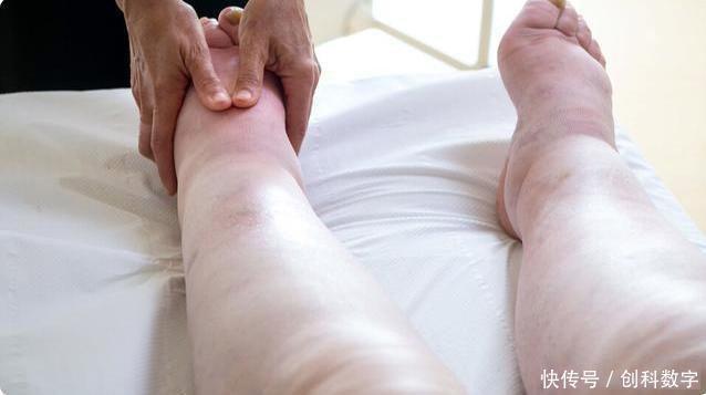 复合菌发酵|尿酸高“根源”确定,不是海鲜啤酒,而是身体这地方