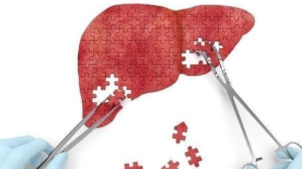 日常生活中|肝硬化不会安静地来,如果身体有三大信号,不要假装你看不到!