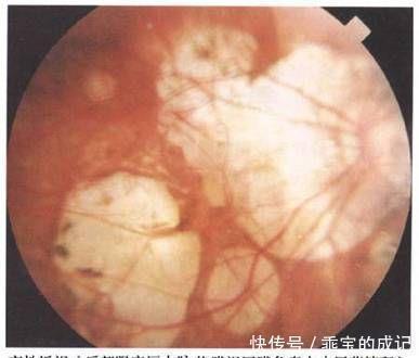 玻璃膜|近视超过600+？我建议你看看自己的眼底，绝对惊恐！