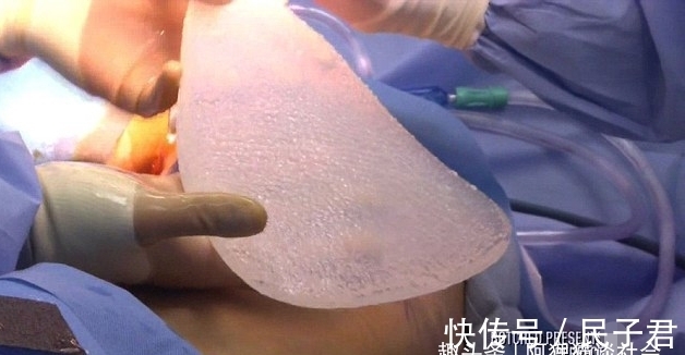翅膀 男子花200万植入翅膀，接受120次整容手术，现与“芭比娃娃”相爱