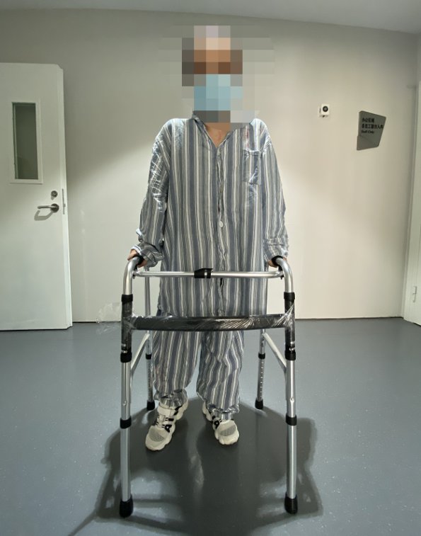 髋臼|髋关节置换手术19年后能否“翻修”?上海九院借助创新3D打印技术定制手术