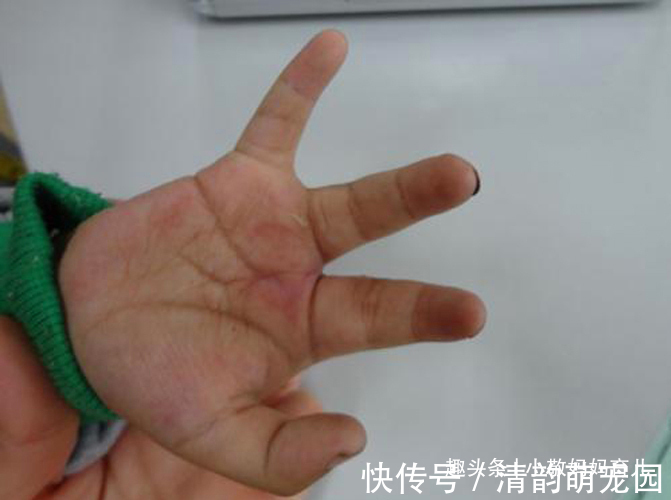 医生|宝宝出生长了“凤爪”,宝妈谎称孕期吃了鸡爪,却被医生当场揭穿