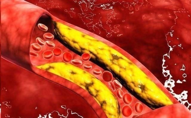 救命恩人|脑梗的“救命恩人”来了,家中常备,血管不堵、血脂稳稳的